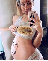 Stretch Marks And Pregnancy